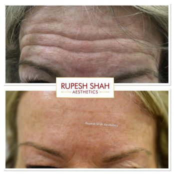 Botox-Before-and-After-Photo-Forehead-Lines-1