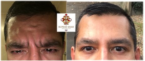 Glabella-Before-and-after